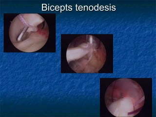 Bicepts tenodesisBicepts tenodesis
 