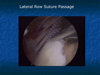 Lateral Row Suture Passage
 