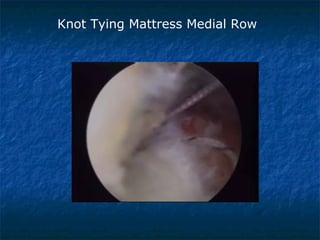 Knot Tying Mattress Medial Row
 