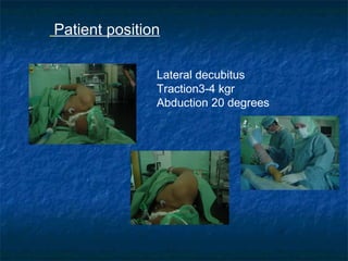 Patient position
Lateral decubitus
Traction3-4 kgr
Abduction 20 degrees
 
