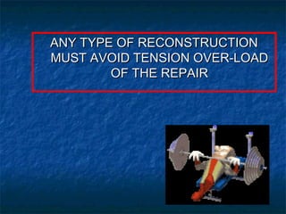 ANY TYPE OF RECONSTRUCTIONANY TYPE OF RECONSTRUCTION
MUST AVOID TENSION OVER-LOADMUST AVOID TENSION OVER-LOAD
OF THE REPAIROF THE REPAIR
 