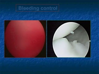 Bleeding control
 