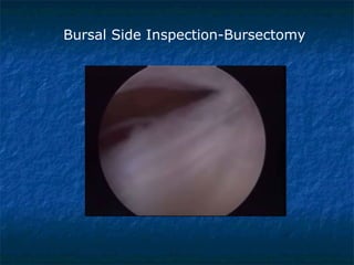 Bursal Side Inspection-Bursectomy
 