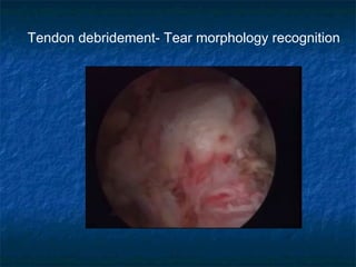 Tendon debridement- Tear morphology recognition
 