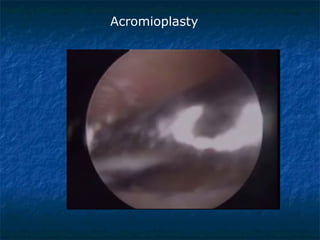 Acromioplasty
 