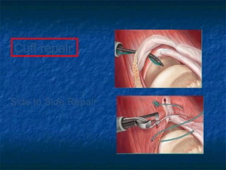Side to Side Repair
Cuff repair
 
