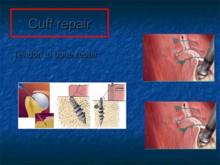 Cuff repairCuff repair
Tendon to bone repairTendon to bone repair
 