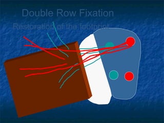 Double Row Fixation
Restoration of the footprint
 