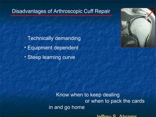 Disadvantages of Arthroscopic Cuff Repair
• Technically demanding
• Equipment dependent
• Steep learning curve
Know when to keep dealing
or when to pack the cards
in and go home
 