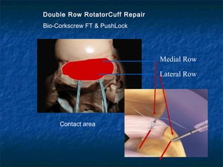 Double Row RotatorCuff Repair
Bio-Corkscrew FT & PushLock
Medial Row
Lateral Row
Contact area
 