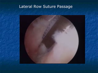 Lateral Row Suture Passage
 