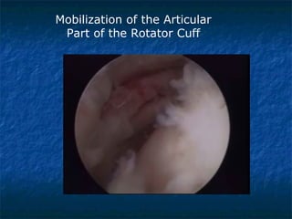 Mobilization of the Articular
Part of the Rotator Cuff
 