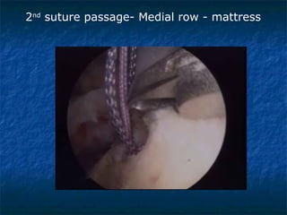 2nd
suture passage- Medial row - mattress
 