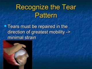Recognize the TearRecognize the Tear
PatternPattern
 Tears must be repaired in theTears must be repaired in the
direction of greatest mobility ->direction of greatest mobility ->
minimal strainminimal strain
 