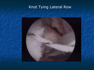Knot Tying Lateral Row
 