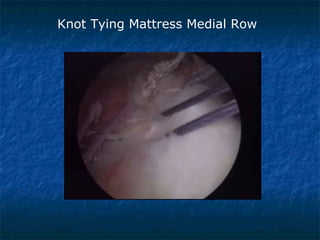 Knot Tying Mattress Medial Row
 
