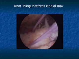 Knot Tying Mattress Medial Row
 