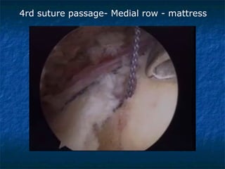 4rd suture passage- Medial row - mattress
 