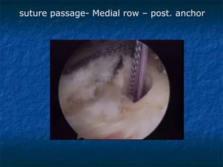 suture passage- Medial row – post. anchor
 