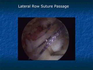 Lateral Row Suture Passage
 