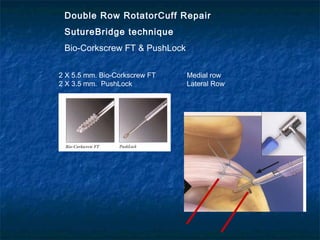 Double Row RotatorCuff Repair
SutureBridge technique
Bio-Corkscrew FT & PushLock
2 X 5.5 mm. Bio-Corkscrew FT Medial row
2 X 3.5 mm. PushLock Lateral Row
 