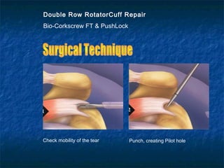 Double Row RotatorCuff Repair
Bio-Corkscrew FT & PushLock
Check mobility of the tear Punch, creating Pilot hole
 
