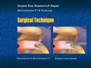 Double Row RotatorCuff Repair
Bio-Corkscrew FT & PushLock
Placement of 2 X Bio-Corkscrews FT Scorpion suture passing
 