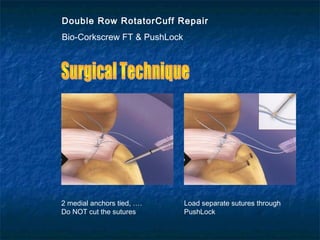 Double Row RotatorCuff Repair
Bio-Corkscrew FT & PushLock
2 medial anchors tied, ….
Do NOT cut the sutures
Load separate sutures through
PushLock
 