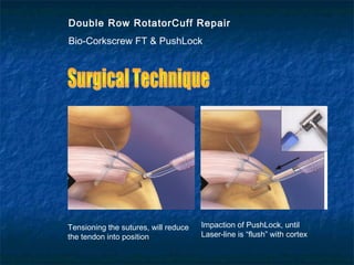 Double Row RotatorCuff Repair
Bio-Corkscrew FT & PushLock
Tensioning the sutures, will reduce
the tendon into position
Impaction of PushLock, until
Laser-line is “flush” with cortex
 