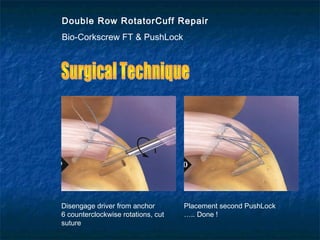 Double Row RotatorCuff Repair
Bio-Corkscrew FT & PushLock
Disengage driver from anchor
6 counterclockwise rotations, cut
suture
Placement second PushLock
….. Done !
 
