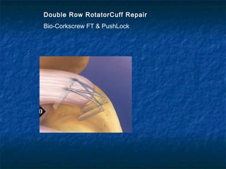 Double Row RotatorCuff Repair
Bio-Corkscrew FT & PushLock
 