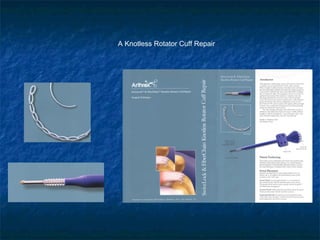 A Knotless Rotator Cuff Repair
 