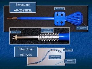 SwiveLock
AR-2323BSL
FiberChain
AR-7270
Thumb Pad
#0 Tip Retention
Suture
Forked Tip
Anchor Body
5.5mm x 15mm
Terminal Link
Free End
(Suture Leader)
#2 FiberWire w/ten
7 mm long loops
 