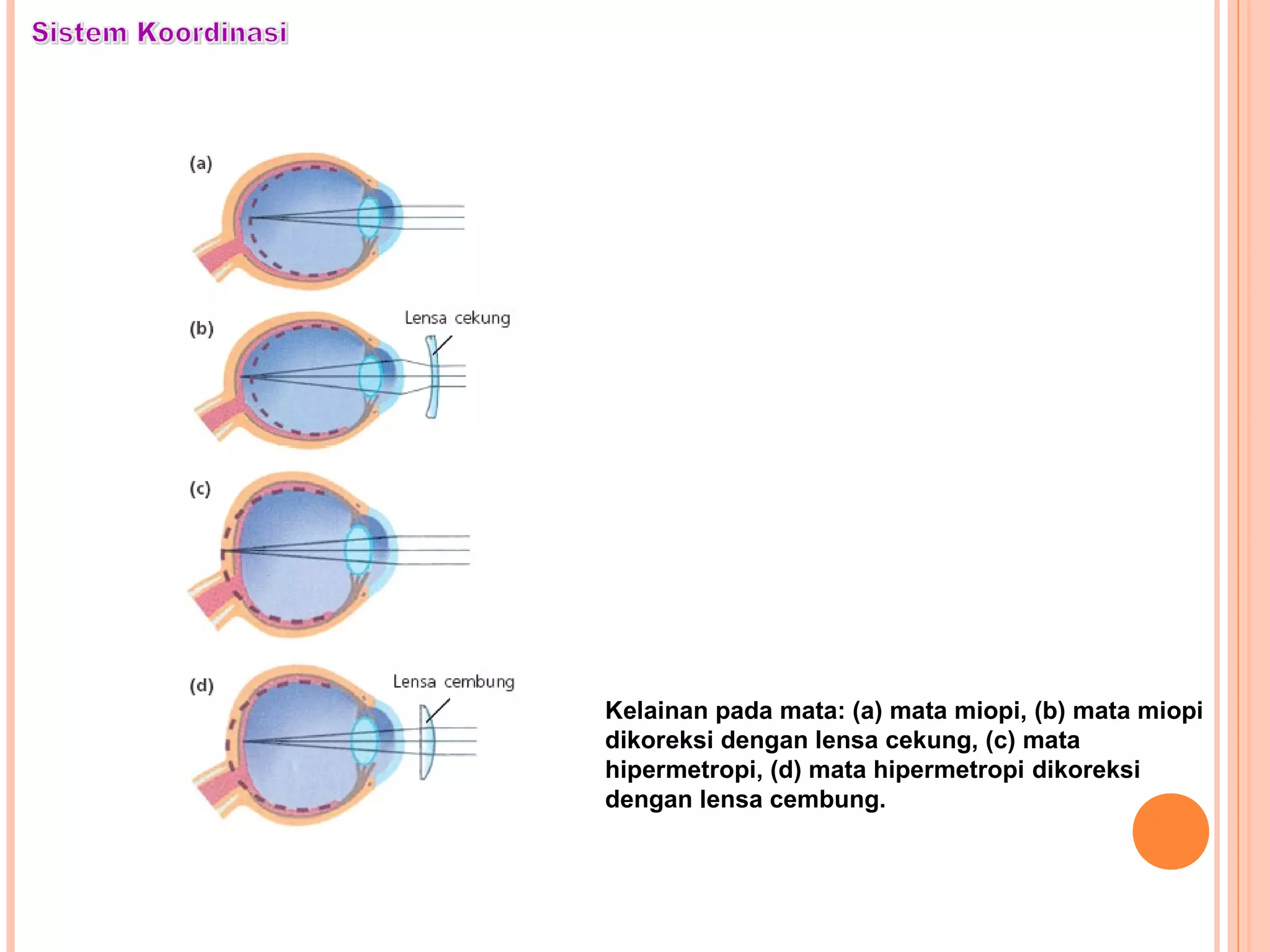Kelainan pada mata: (a) mata miopi, (b) mata miopi
dikoreksi dengan lensa cekung, (c) mata
hipermetropi, (d) mata hipermetropi dikoreksi
dengan lensa cembung.
 