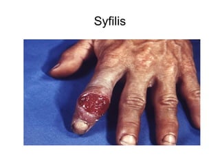 Syfilis
 