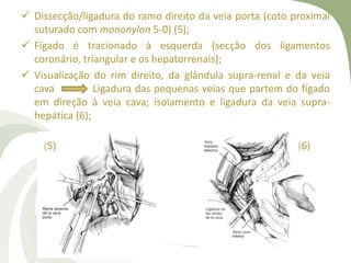  Dissecção/ligadura do ramo direito da veia porta (coto proximal
suturado com mononylon 5-0) (5);
 Fígado é tracionado à esquerda (secção dos ligamentos
coronário, triangular e os hepatorrenais);
 Visualização do rim direito, da glândula supra-renal e da veia
cava Ligadura das pequenas veias que partem do fígado
em direção à veia cava; isolamento e ligadura da veia supra-
hepática (6);
(5) (6)
 