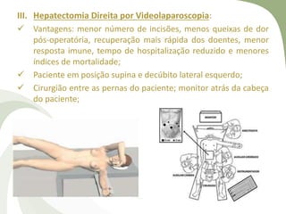 III. Hepatectomia Direita por Videolaparoscopia:
 Vantagens: menor número de incisões, menos queixas de dor
pós-operatória, recuperação mais rápida dos doentes, menor
resposta imune, tempo de hospitalização reduzido e menores
índices de mortalidade;
 Paciente em posição supina e decúbito lateral esquerdo;
 Cirurgião entre as pernas do paciente; monitor atrás da cabeça
do paciente;
 