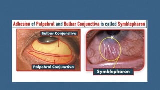 Adhesion between the Palpebral and bulbar conjunctiva, the lid become ...
