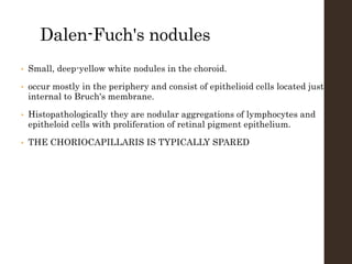 Dalen-Fuch's nodules
• Small, deep-yellow white nodules in the choroid.
• occur mostly in the periphery and consist of epithelioid cells located just
internal to Bruch's membrane.
• Histopathologically they are nodular aggregations of lymphocytes and
epitheloid cells with proliferation of retinal pigment epithelium.
• THE CHORIOCAPILLARIS IS TYPICALLY SPARED
 
