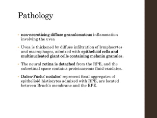 Pathology
• non-necrotizing diffuse granulomatous inflammation
involving the uvea
• Uvea is thickened by diffuse infiltration of lymphocytes
and macrophages, admixed with epithelioid cells and
multinucleated giant cells containing melanin granules.
• The neural retina is detached from the RPE, and the
subretinal space contains proteinaceous fluid exudates.
• Dalen-Fuchs’ nodules: represent focal aggregates of
epithelioid histiocytes admixed with RPE, are located
between Bruch’s membrane and the RPE.
 