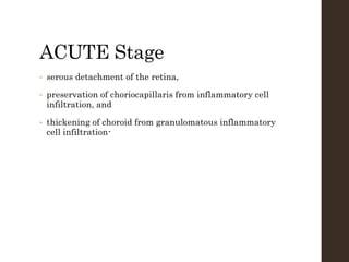 ACUTE Stage
• serous detachment of the retina,
• preservation of choriocapillaris from inflammatory cell
infiltration, and
• thickening of choroid from granulomatous inflammatory
cell infiltration-
 