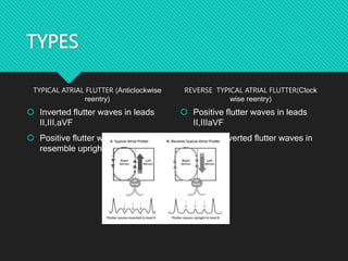 Supraventricular tacchyarrhythmias a breif discussion | PPTX