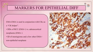 IHC in cancer diagnosis | PPTX