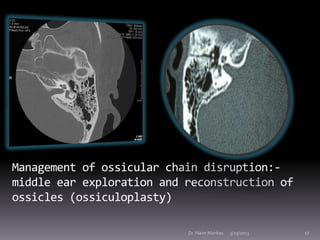 Management of ossicular chain disruption:-
middle ear exploration and reconstruction of
ossicles (ossiculoplasty)

       ...