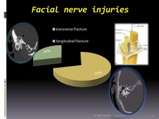 Facial nerve injuries

        transverse fracture


        longitudnal fracture

  20%




                             ...