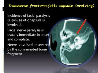 Transverse fractures(otic capsule involving)

Incidence of facial paralysis
is 50% as otic capsule is
involved.
Facial ner...
