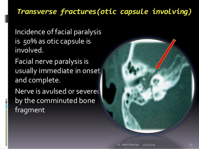 temporal bone fractures