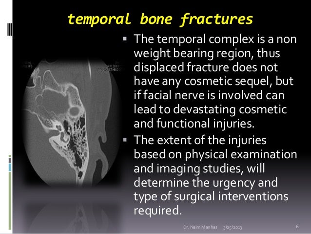 Temporal Bone Fracture Longitudinal Vs Transverse