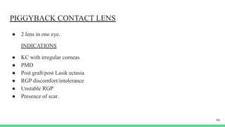 Piggyback Rgp Symposium ectasia of cornea, keratonus, pmd, tmd | PDF