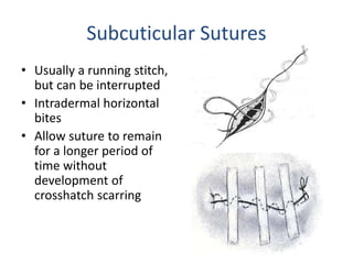 Subcuticular Stitch R Symposium sutures grafts and meshes amit and vipin | PPT